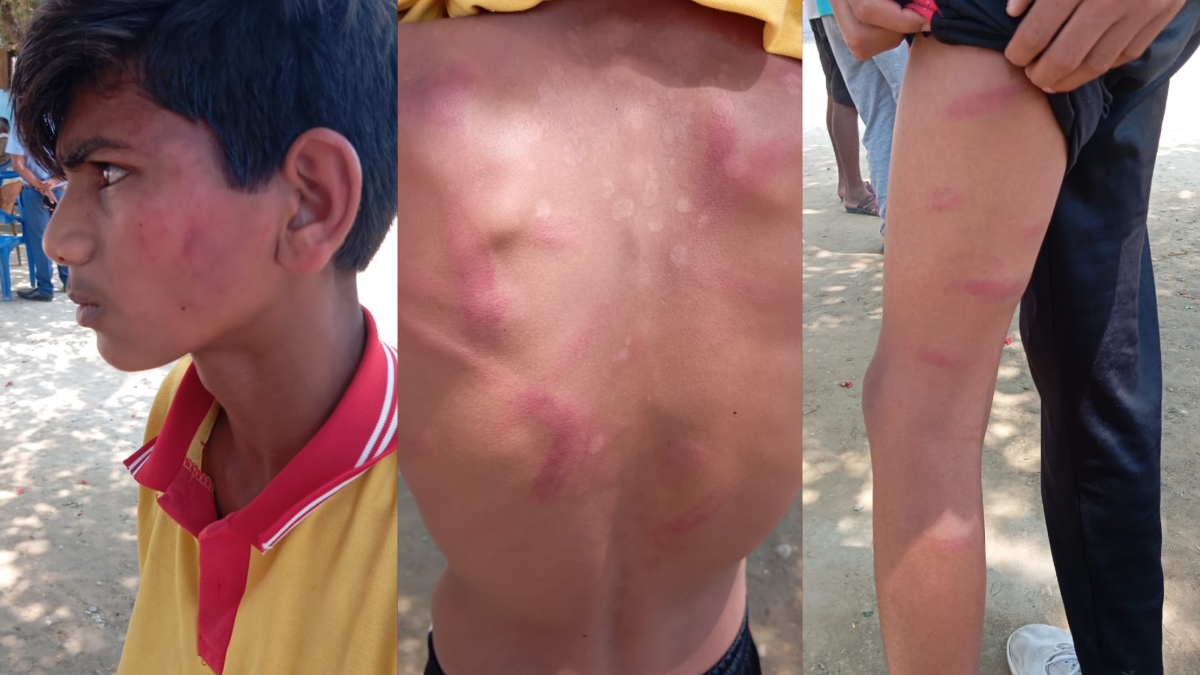 शिक्षकको कुटाइबाट १३ वर्षीय विद्यार्थी अविनास अस्पताल भर्ना