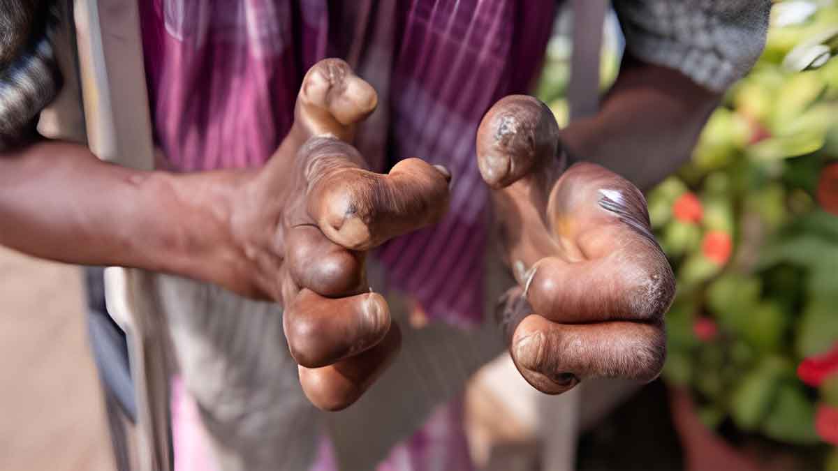 बाँके कुष्ठरोगको उच्च जोखिममा